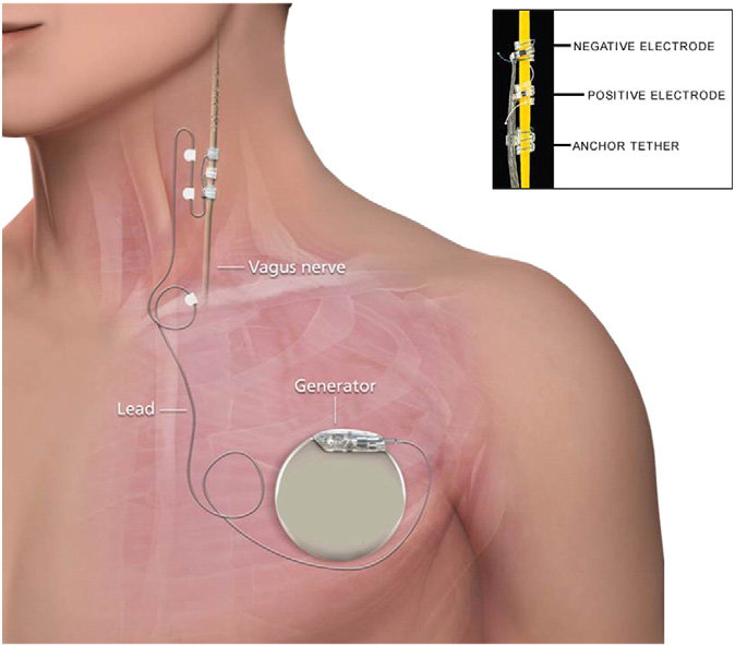 Placement of vagus nerve stimulation device. As illustrated in the insert (upper right box), the distal end of the lead is wrapped around the nerve.